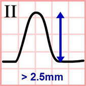 ECG P Pulmonale (symmetrically peaked P wave) in lead II