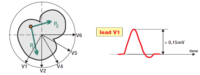 P pulmonale (biphasic) in horizontal plane, lead V1