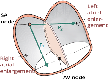 Biatrial enlargement, P cardiale, P biatriale