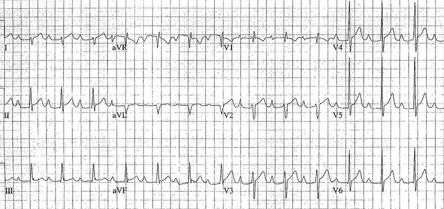 ECG biatrial abnormality (enlargement) P pulmonale and P mitrale