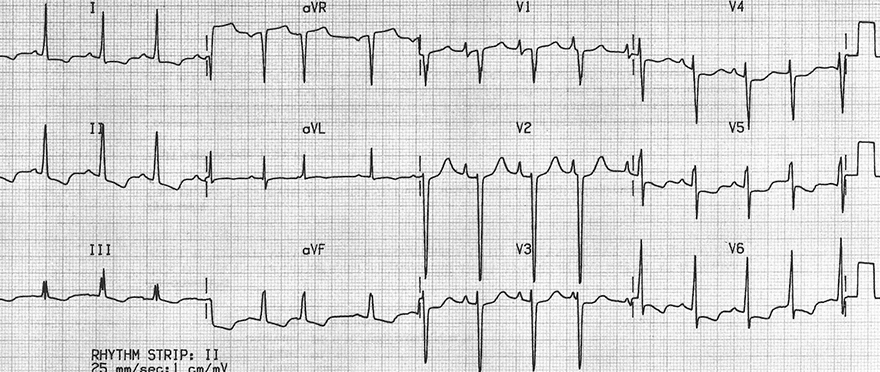 ECG dilatation cardiomyopathy with biatrial enlargement, biatrial hypertrophy, P cardiale, P biatriale, 