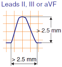 ECG (Lead II) Bifid P wave: P cardiale, P biatriale, Biatrial enlargement