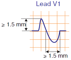 ECG (Lead V1) Biphasic P wave: P cardiale, P biatriale, Biatrial enlargement