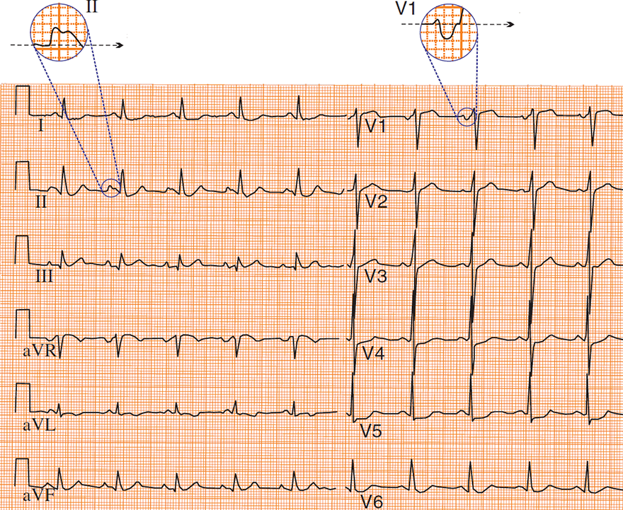 ECG p mitrale (Left Atrial Enlargement)