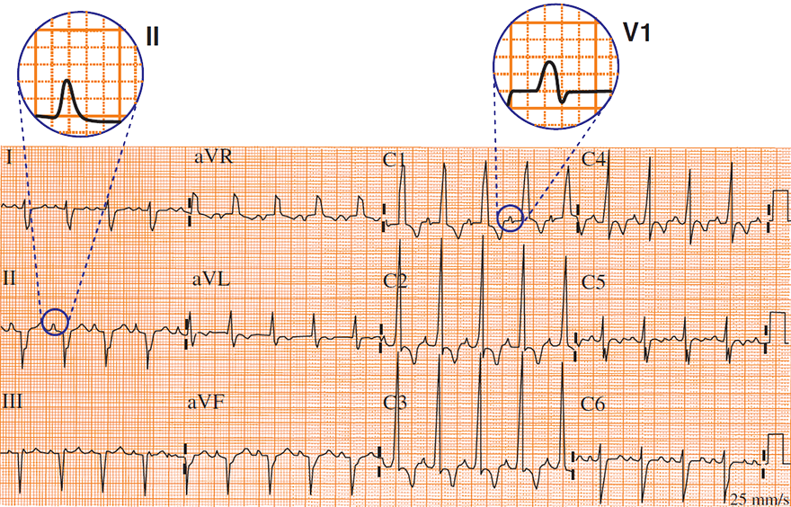 ECG P pulmonale (Right Atrial Enlargement)