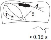 ECG - Advanced interatrial (Bachmann) block with left atrial retrograde activation, type 3