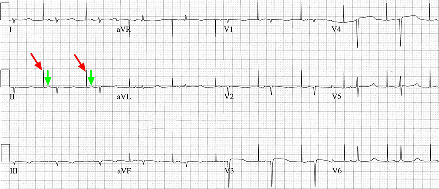 ECG atrial pacing and interatrial (Bachmann) block (type 1)