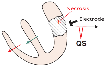 ECG pathological Q wave, myocardial infarction, electrical window