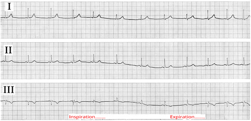 ECG lead III large respiratory q wave, due to electrical axis deviation during inspiration and expiration