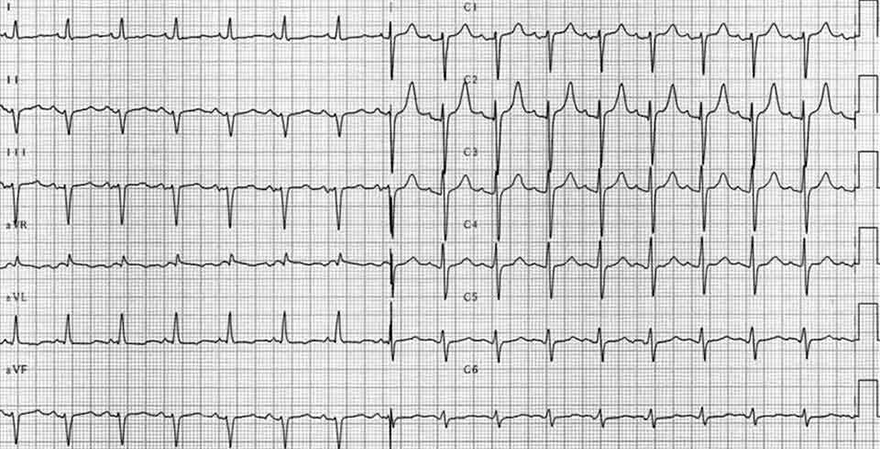 ECG pathologic Q wave, left anterior hemiblock (LAH)