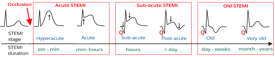 Evolution of STEMI infarction, Development of pathological Q wave in subacute and chronic stages of STEMI