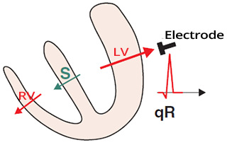 Develop normal Q wave, septum depolarization electrical activity