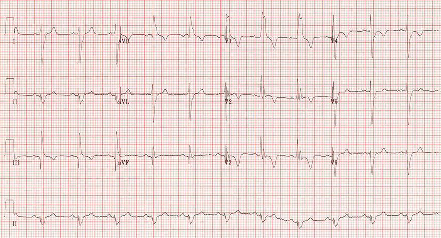 ECG acute pulmonary embolism, pathologic Q wave (III), S1Q3T3 pattern