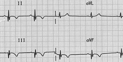 ECG pathological Q wave in inferior leads (II, III, aVF), old inferior STEMI infarction