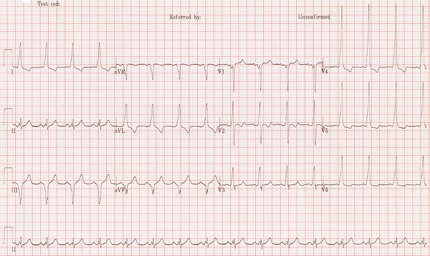 ECG pathologic Q wave, WPW syndrome