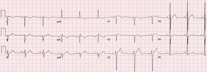 ECG limb leads reversal displacement, develop pathologic Q wave