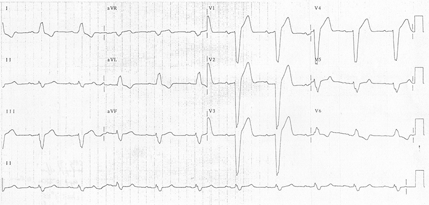 ECG pathological Q wave, Left bundle branch block (LBBB)