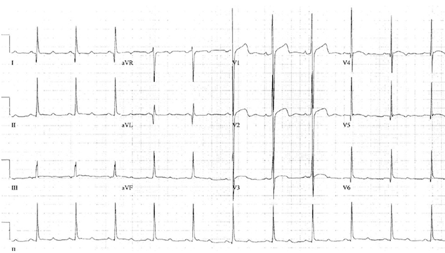 ECG pathologic Q wave, septal hypertrophy, hypertrophic cardiomyopathy