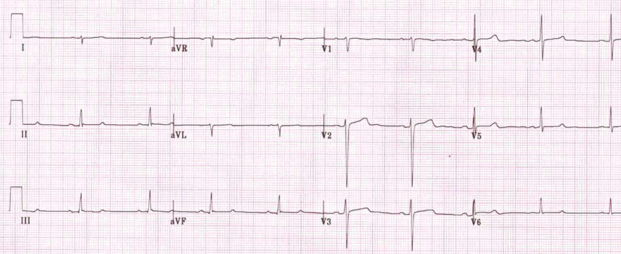 ECG pathologic Q wave, left posterior hemiblock