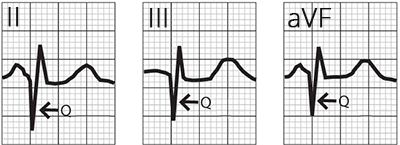 ECG definition of pathologic Q wave, old inferior STEMI infarction