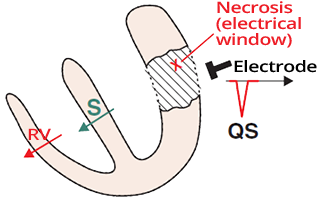 Develop pathologic Q wave, electrical hole, previous myocardial infarction