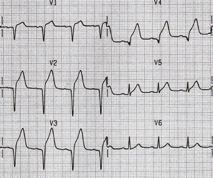 ECG criteria pathologic Q wave, subacute antero-septal STEMI infarction