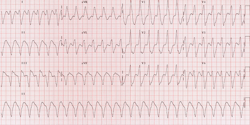 ECG ventricular tachycardia with dominant R wave in aVR lead