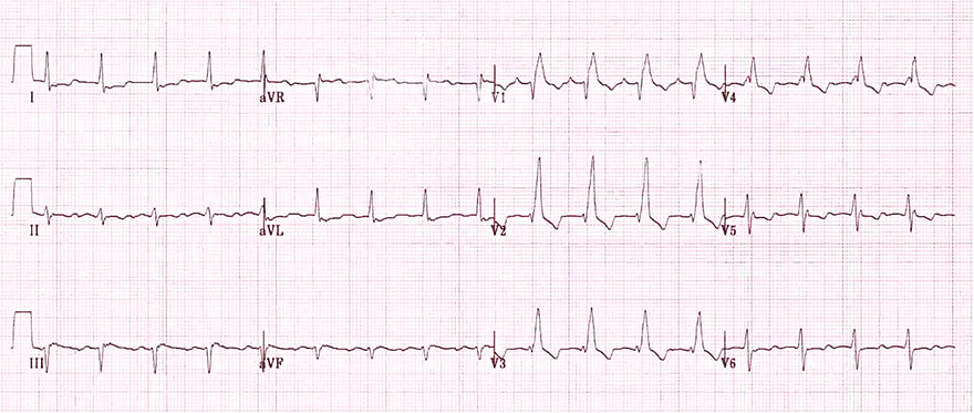 ECG right bundle branch block with dominant R wave V1, V2