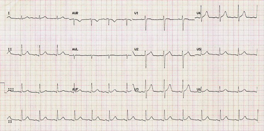 ECG normal R wave progression