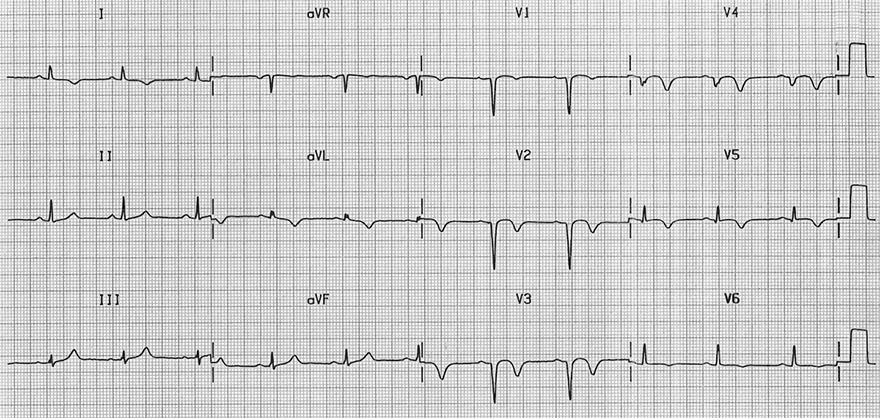 ECG old antero-septal STEMI infarction, poor R wave progression, pathological q wave