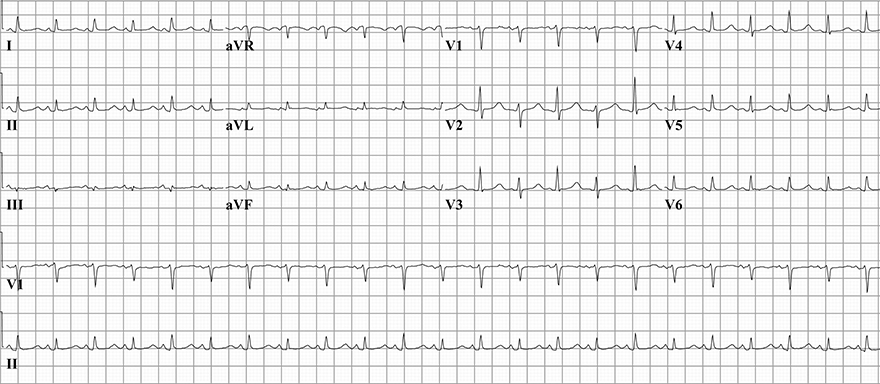 ECG QRS alternans, changing amplitude R wave. Pericardial effusion