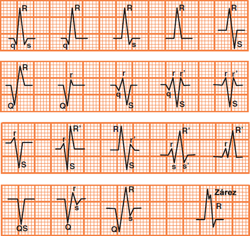 R wave and QRS complex nomenclature (configuration) variation (qRs, qR, Rs, R, RS, QR, rQ, Qr, qrS, qrSr, rS, rSR, QS, Qrs, R wave notched)