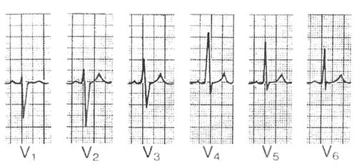 R wave amplitude, axis, RS transition zone ECG