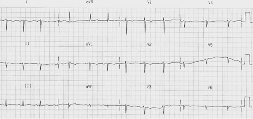 ECG dextrocardia and poor r wave progression, right axis deviation