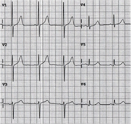 ECG lead misplacement V1 and V3 with poor R wave progression