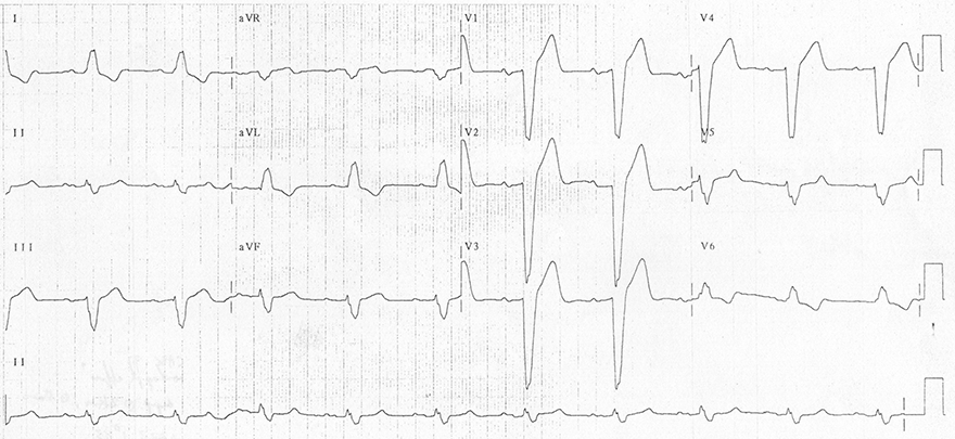 Poor R Wave Progression - ECG book