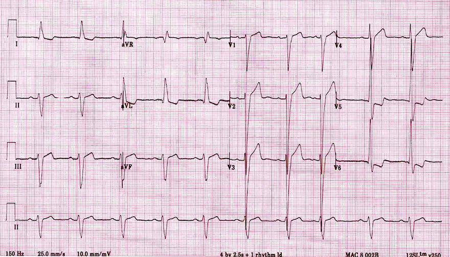 ECG poor r wave progression and left ventricular hypertrophy