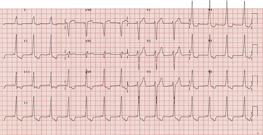 ECG WPW syndrome type B and poor R wave progression