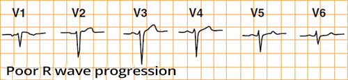 ECG poor R wave progression in chest leads