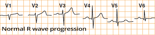 ECG R wave progression in precordial leads