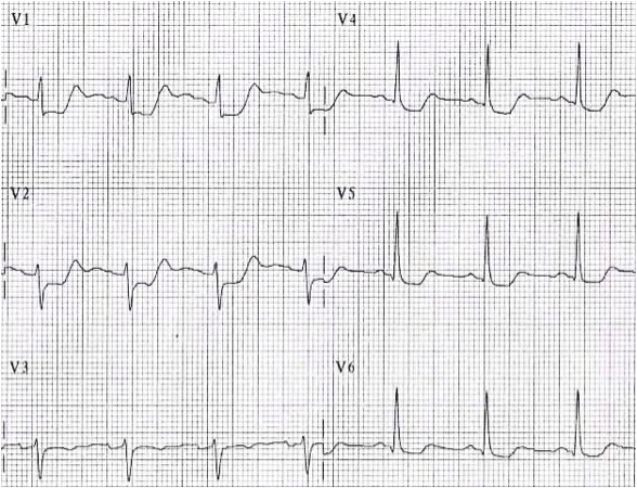 ECG dominant r wave V1 and posterior STEMI infarction