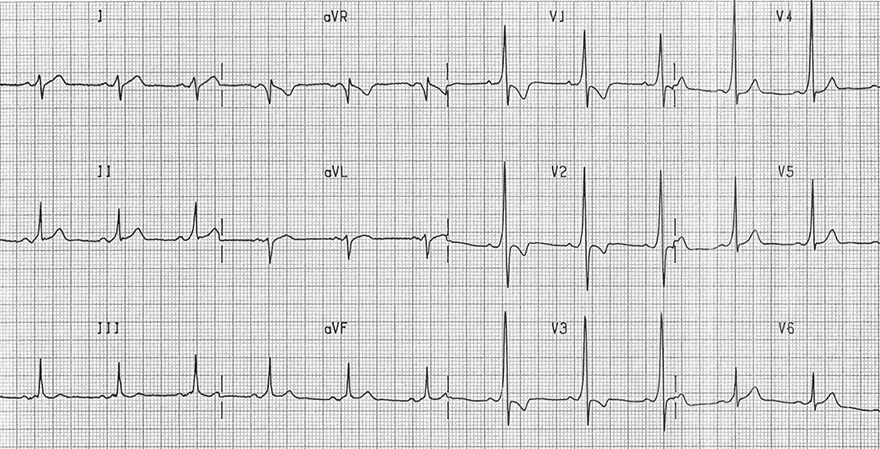 ECG dominant r wave V1 and WPW syndrome type A