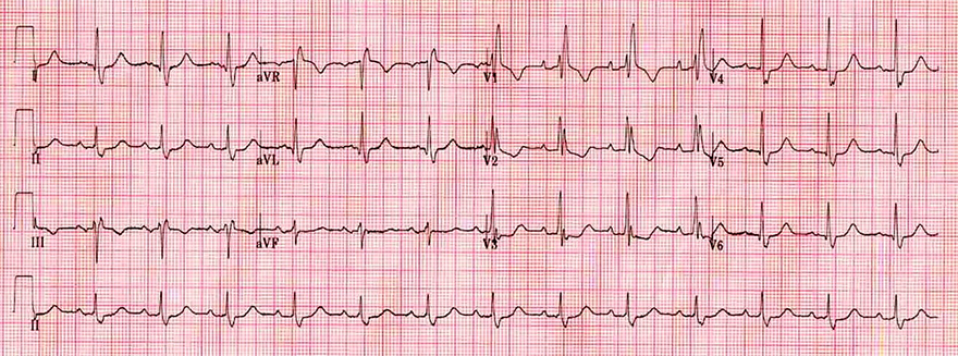 ECG dominant R wave V1 and complete right bundle branch block (RBBB)