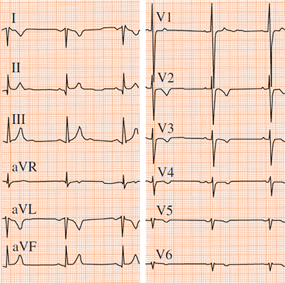 ECG dextrocardia with poor R wave progression