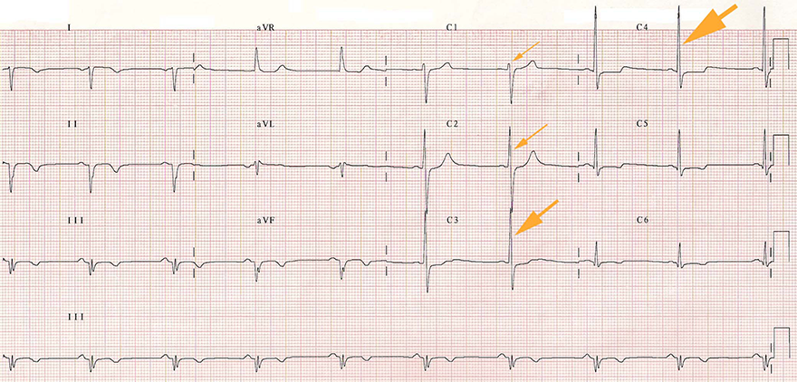 Dextrocardia - ECG book