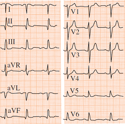 ECG reversal of the left and right arm electrodes, with normal R wave progression