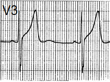 ECG T wave and benign early repolarisation