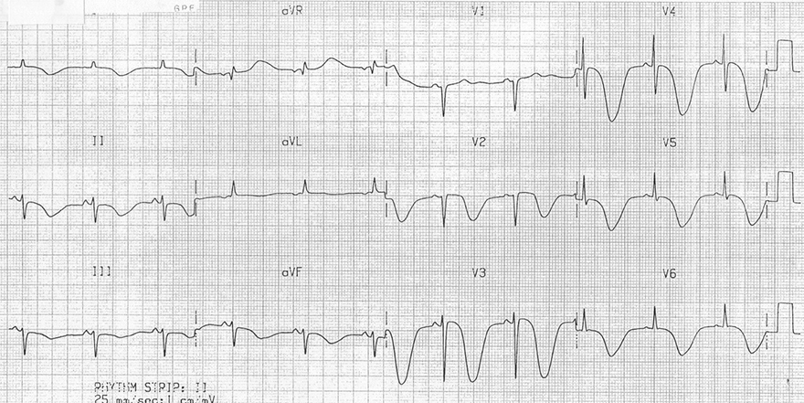 ECG inverted cerebral T waves and raised intracranial pressure