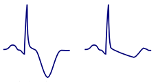 ECG T wave disconcordance