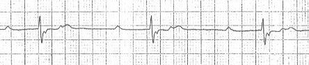 ECG double camel hump T waves and sedond degree (2nd) AV heart block, Mobitz 2 (2:1)